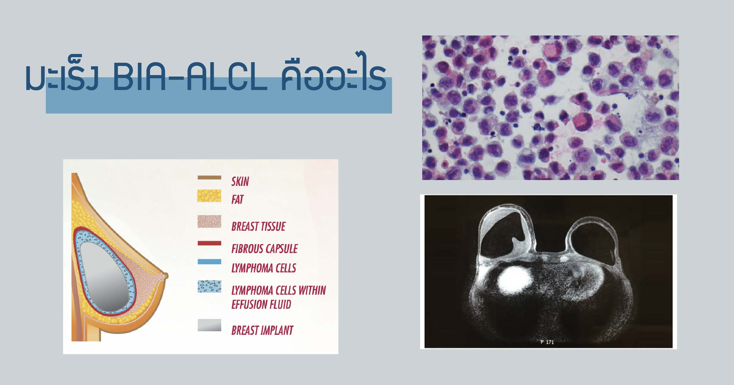 BIA-ALCL คือ มะเร็ง BIA ALCL