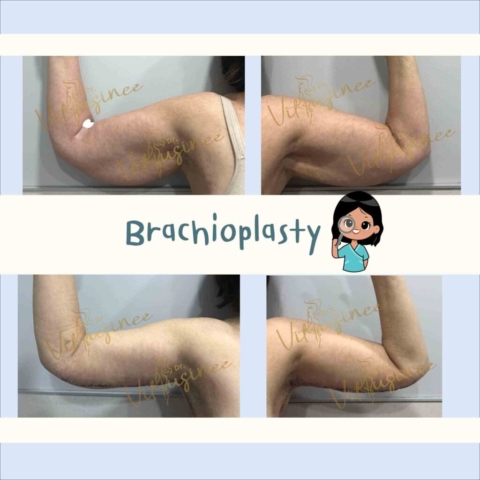 ตัดท้องแขน arm lift