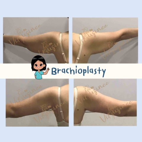 ตัดท้องแขน arm lift