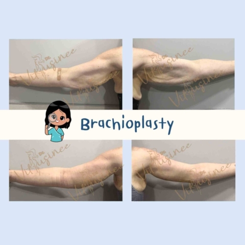 ตัดท้องแขน arm lift