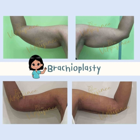 ตัดท้องแขน arm lift