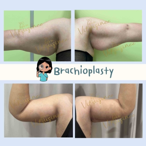 ตัดท้องแขน arm lift