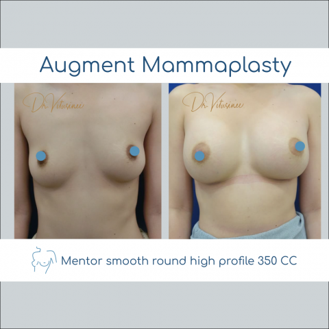 breast augmentation smooth round profile