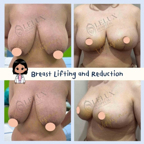 Breast reduction ยกกระชับหน้าอก ลดขนาดหน้าอก
