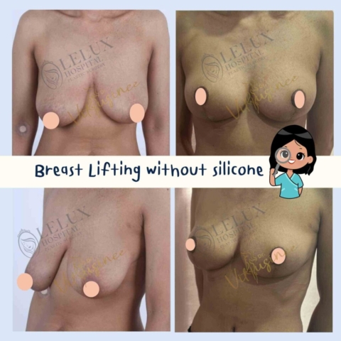mastopexy ยกกระชับหน้าอก ลดขนาดหน้าอก