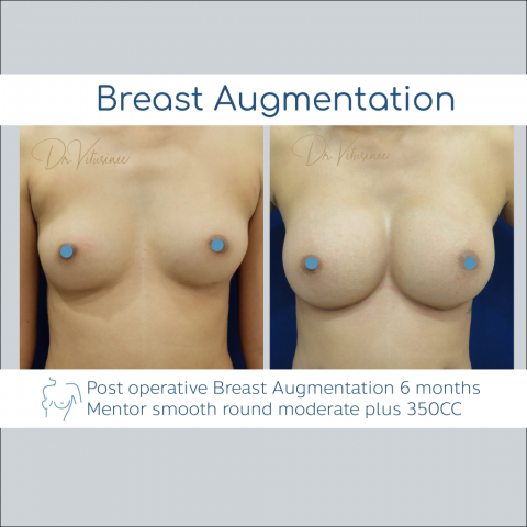breast augmentation smooth round profile