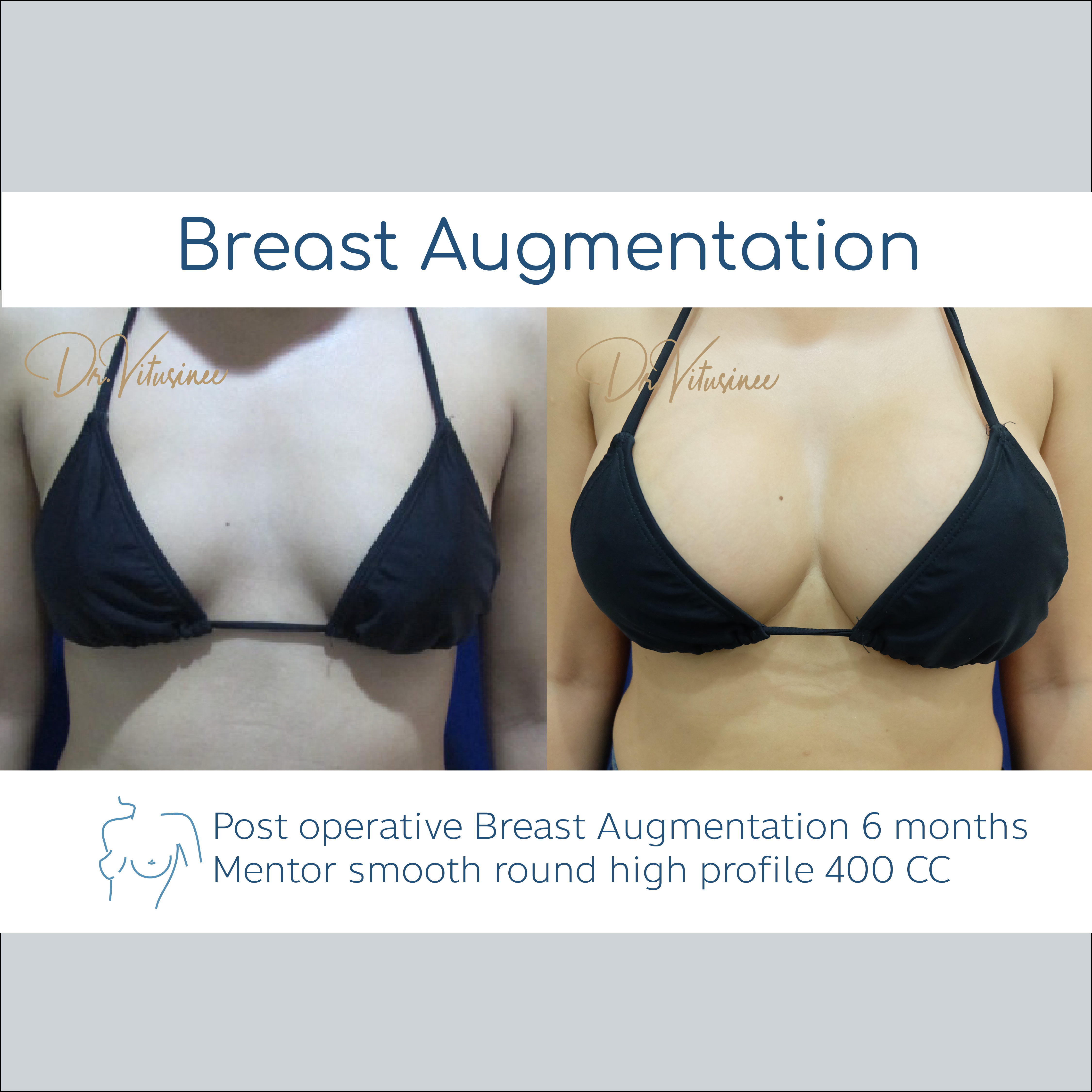 breast augmentation smooth round profile mentor