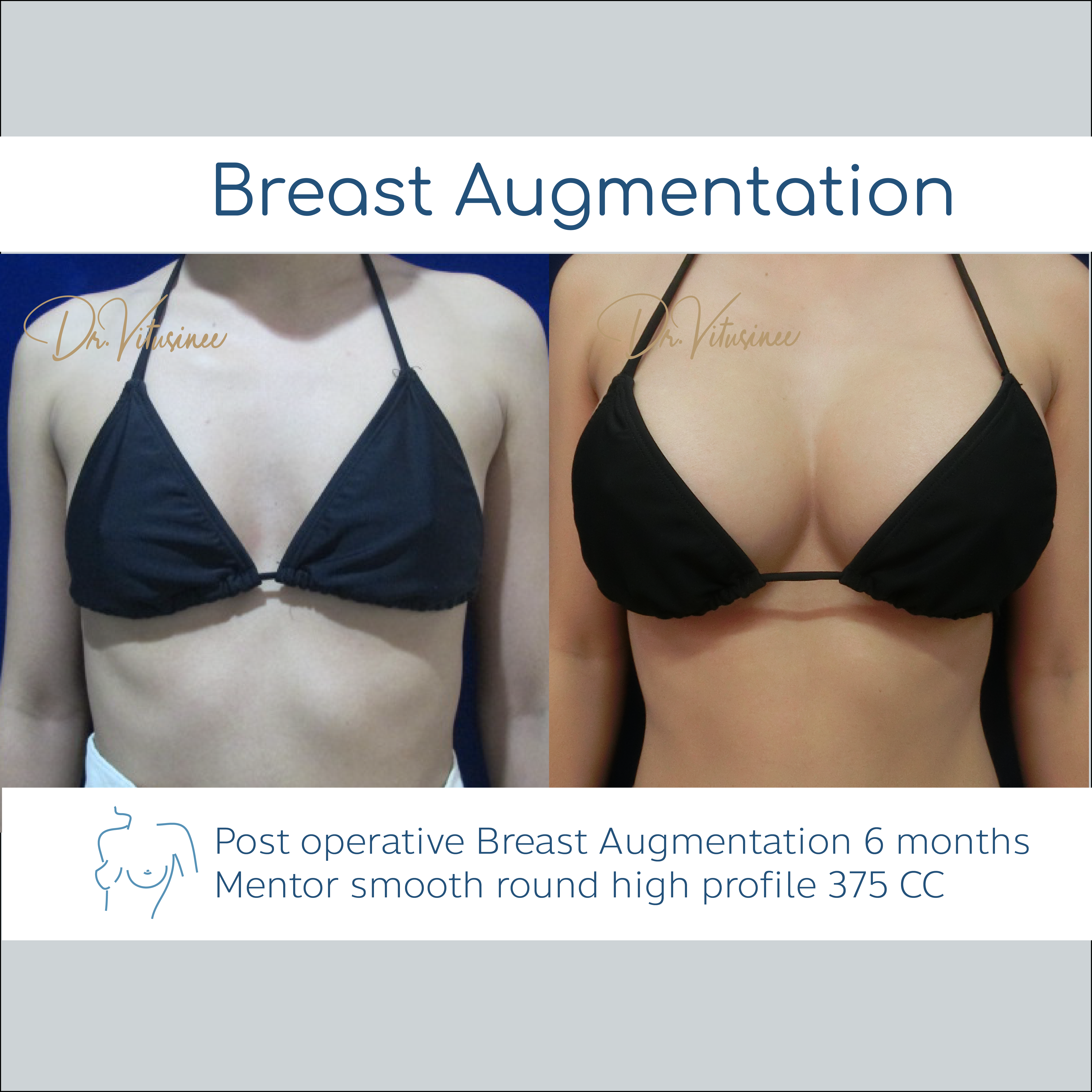 breast augmentation smooth round profile mentor