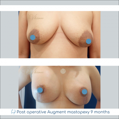 augment mastopexy breast lift