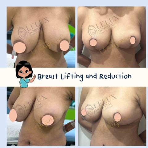 Breast reduction ยกกระชับหน้าอก ลดขนาดหน้าอก