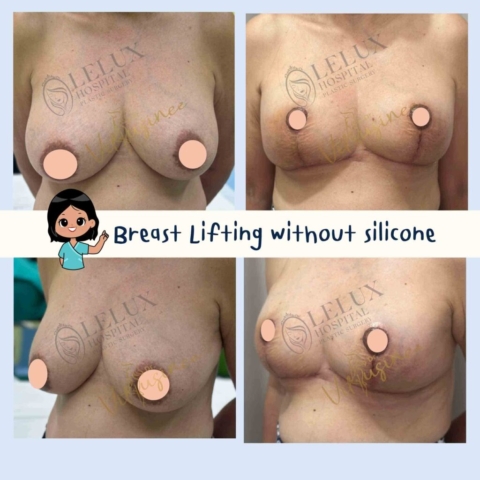 mastopexy ยกกระชับหน้าอก ลดขนาดหน้าอก