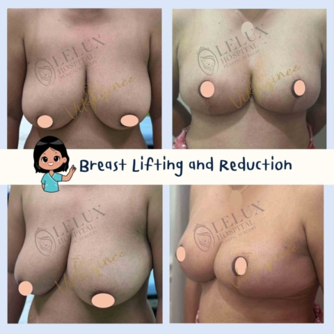 Breast reduction ยกกระชับหน้าอก ลดขนาดหน้าอก