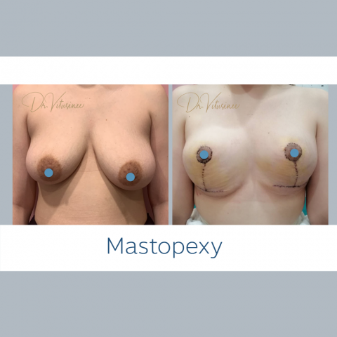 Mastopexy without silicone Breast lift