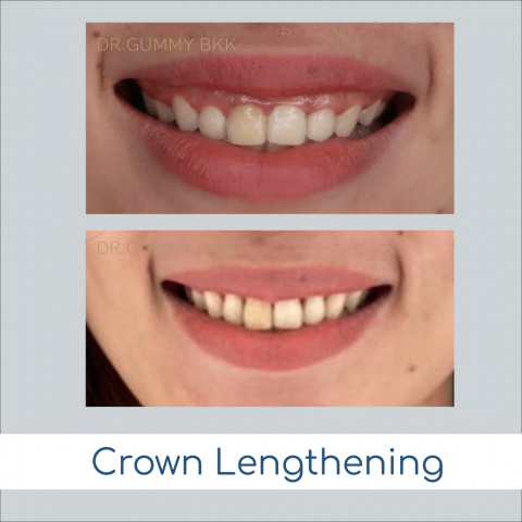 crown lengthening gummy smile surgery