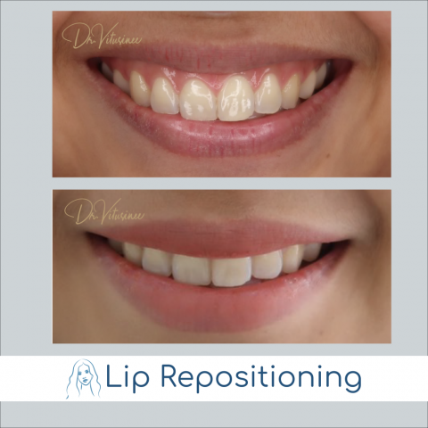 lip repositioning gummy smile surgery