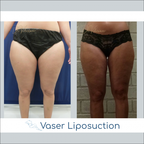 vaser liposuction thigh