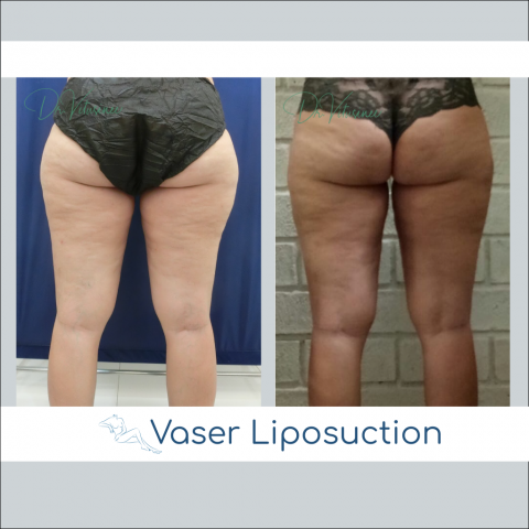 vaser liposuction thigh and hip