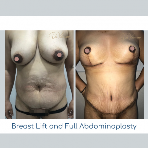 mummy make over mastopexy without silicone breast lift
