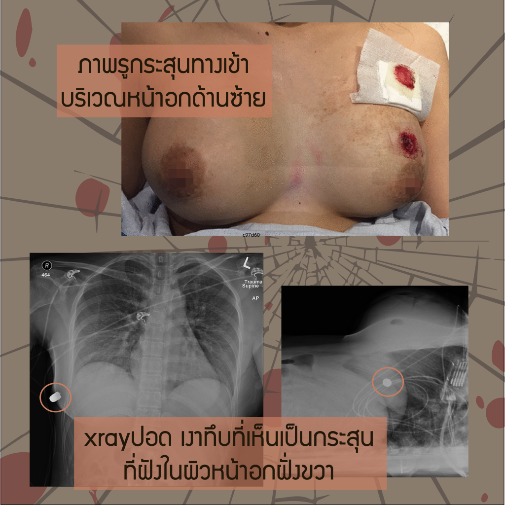 breast silicone safe life gun shot wound - silicone เสริมหน้าอก ช่วยชีวิต
