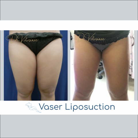 vaser liposuction thigh and hip