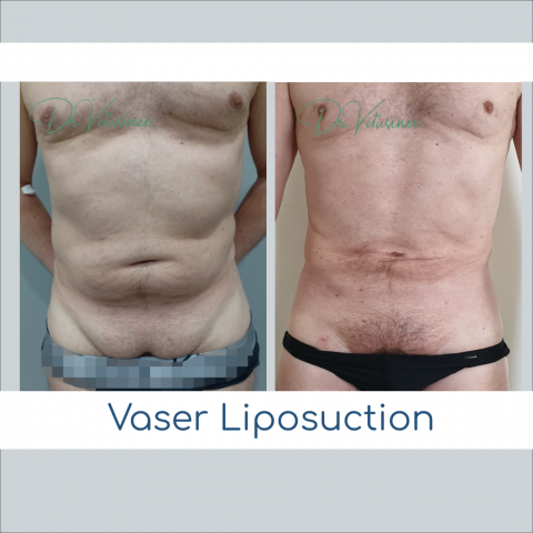 vaser liposuction abdomen tummy