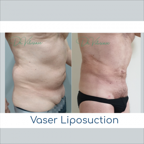 vaser liposuction abdomen tummy and waist