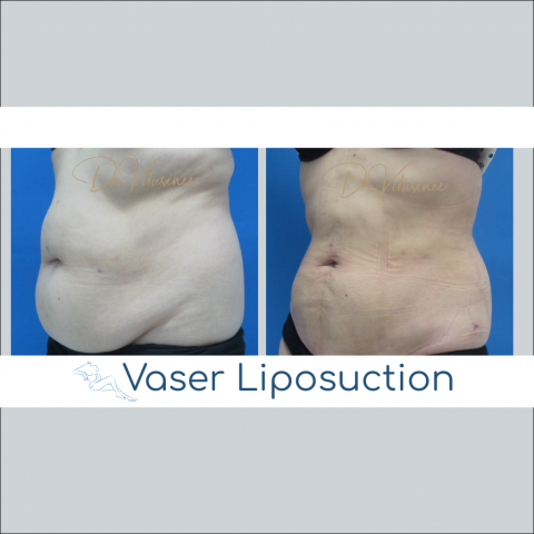 vaser liposuction abdomen tummy waist