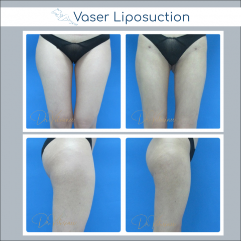 vaser liposuction whole thigh and hip