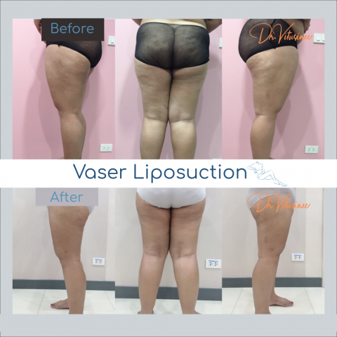 vaser liposuction whole thigh and hip