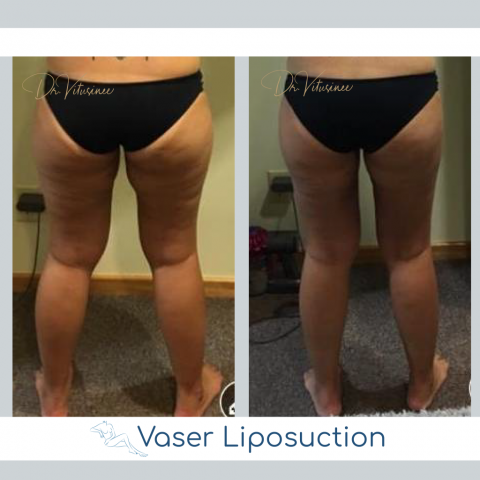 vaser liposuction thigh