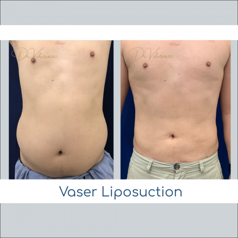 vaser liposuction tummy and waist