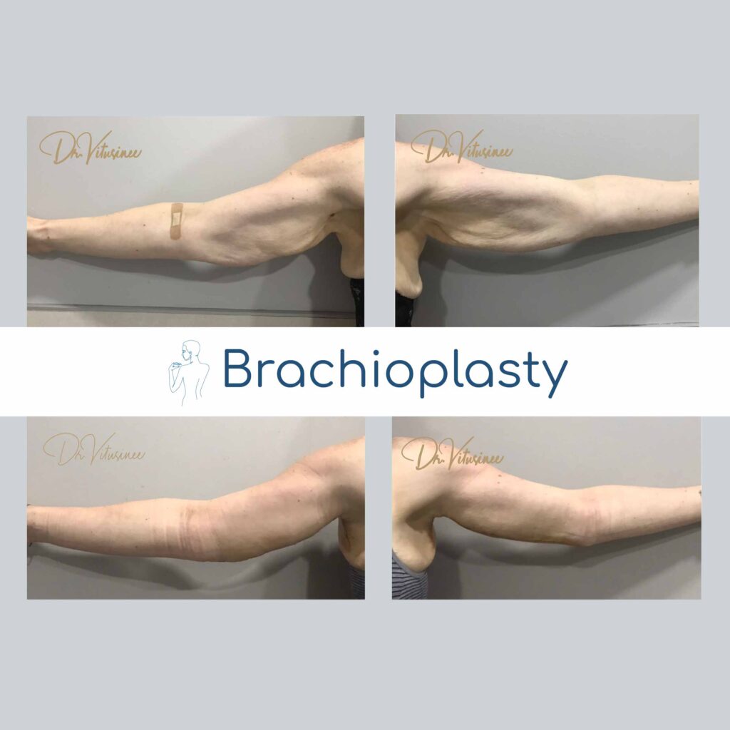 กระชับต้นแขน ศัลยกรรมกระชับท้องแขน brachioplasty arm lift